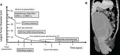 Case report and literature review: Conversion surgery for initially unresectable huge retroperitoneal liposarcoma after preoperative radiotherapy